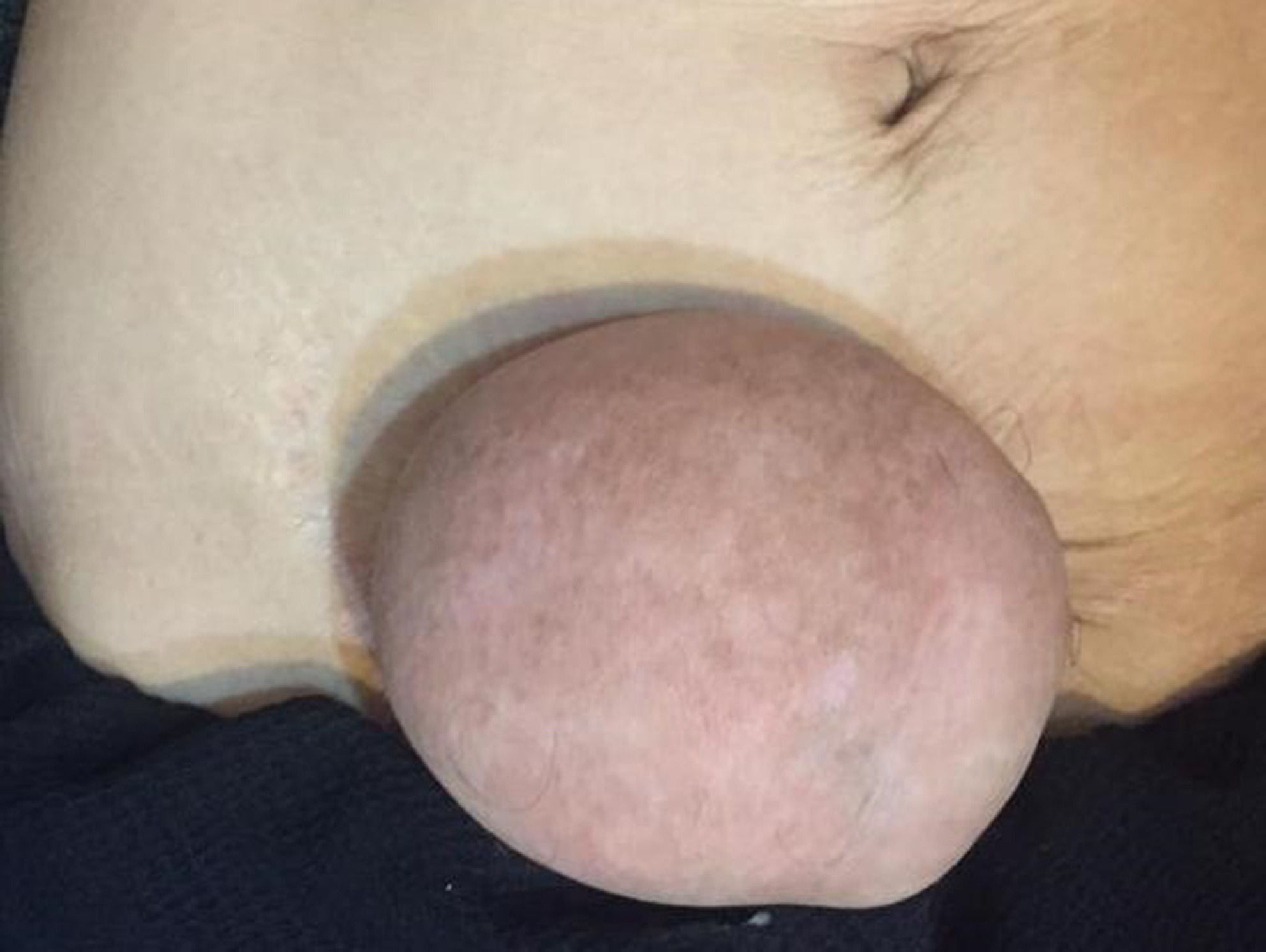 Pseudoangiomatous stromal hyperplasia of the breast: A case report