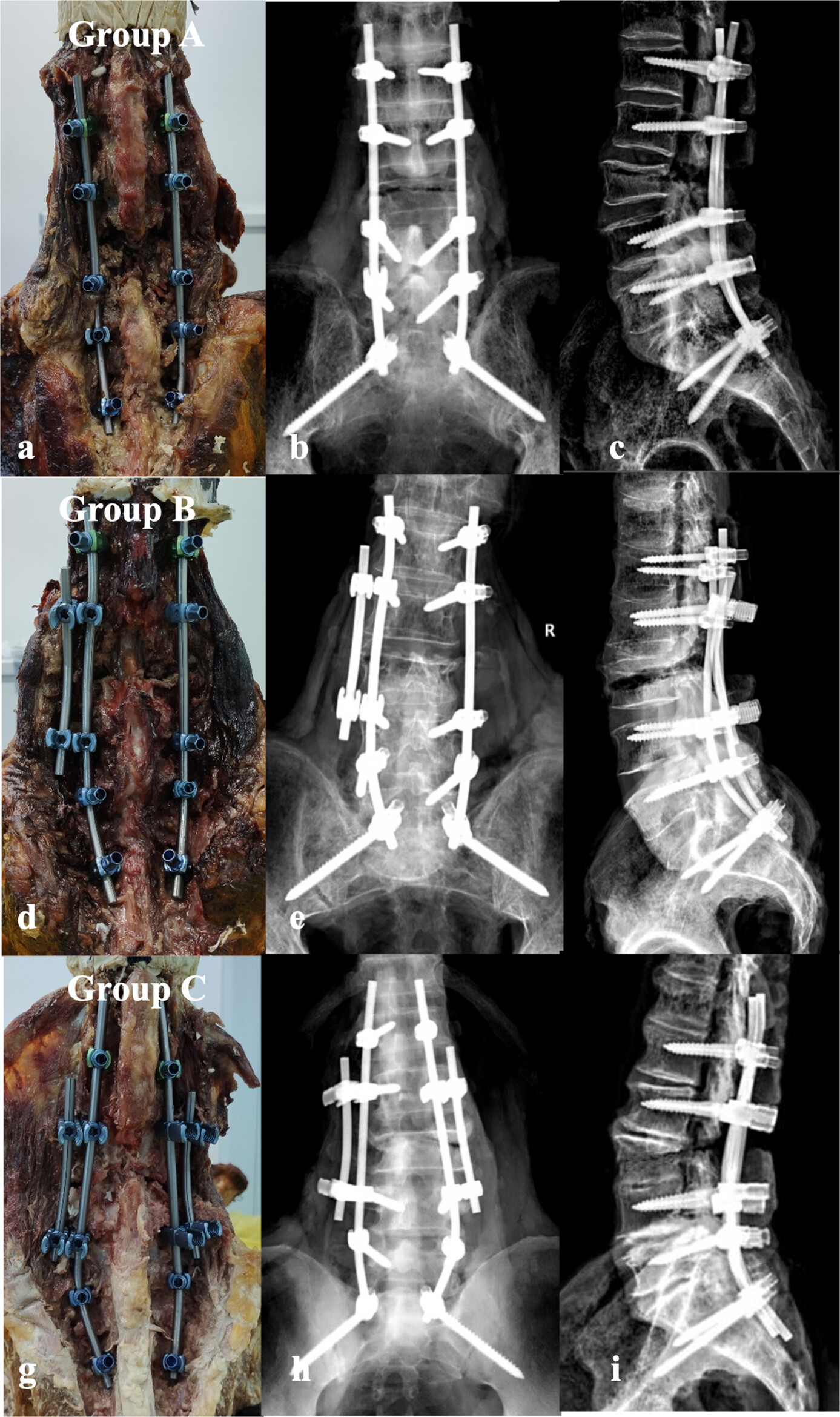 Biomechanical Advantages of Novel Duet Screws Plus Bilateral Satellite Rods Fixation in the Correction Surgery for Adult Spinal Deformity Issue ,