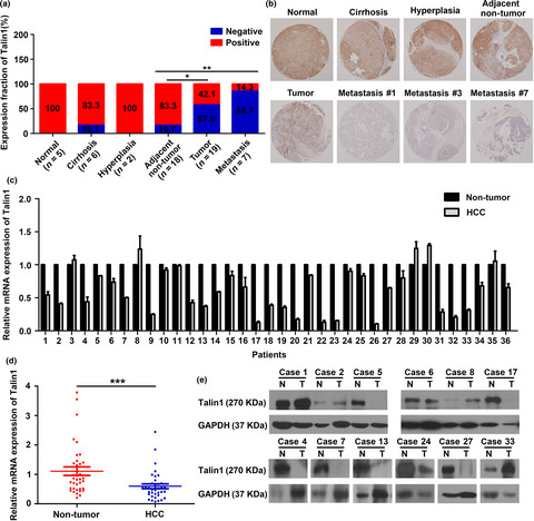 Downregulation of Talin1 promotes hepatocellular carcinoma progression through activation of the ERK1/2 pathway