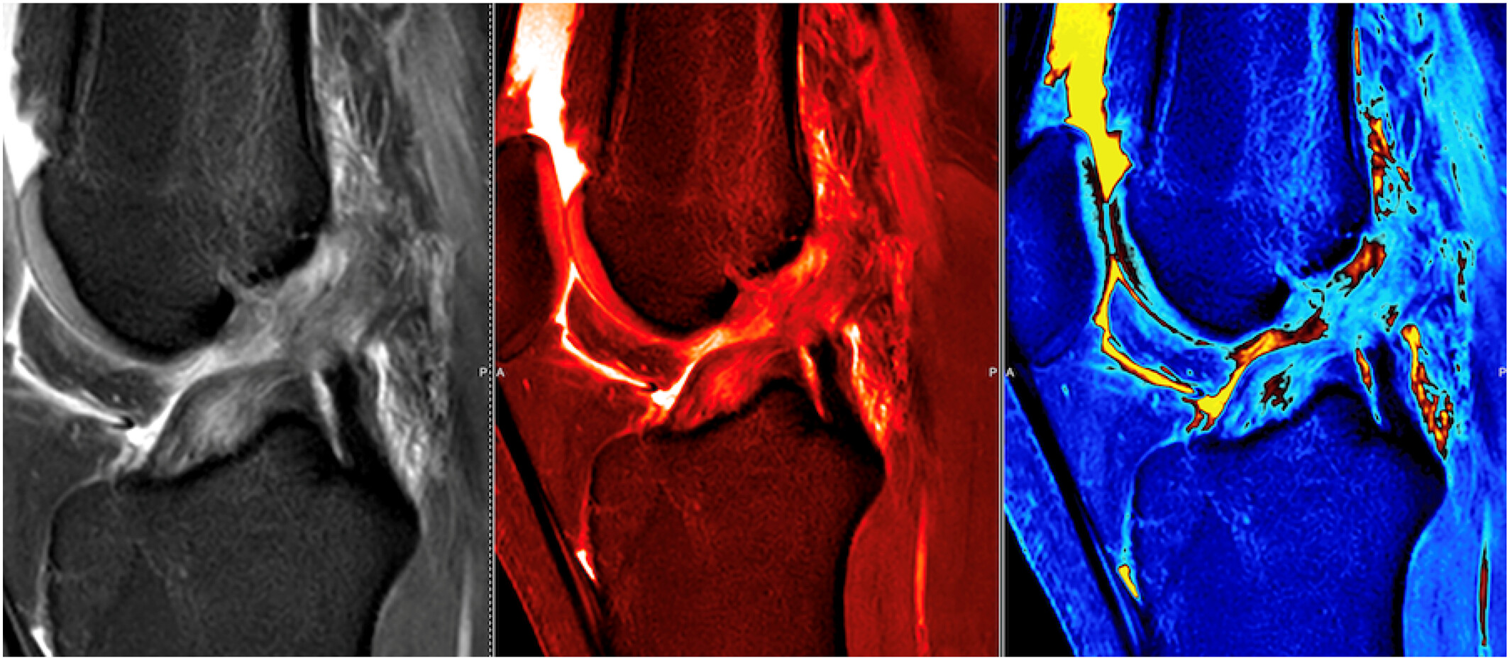 Automated Color Coding in Musculoskeletal MR Imaging