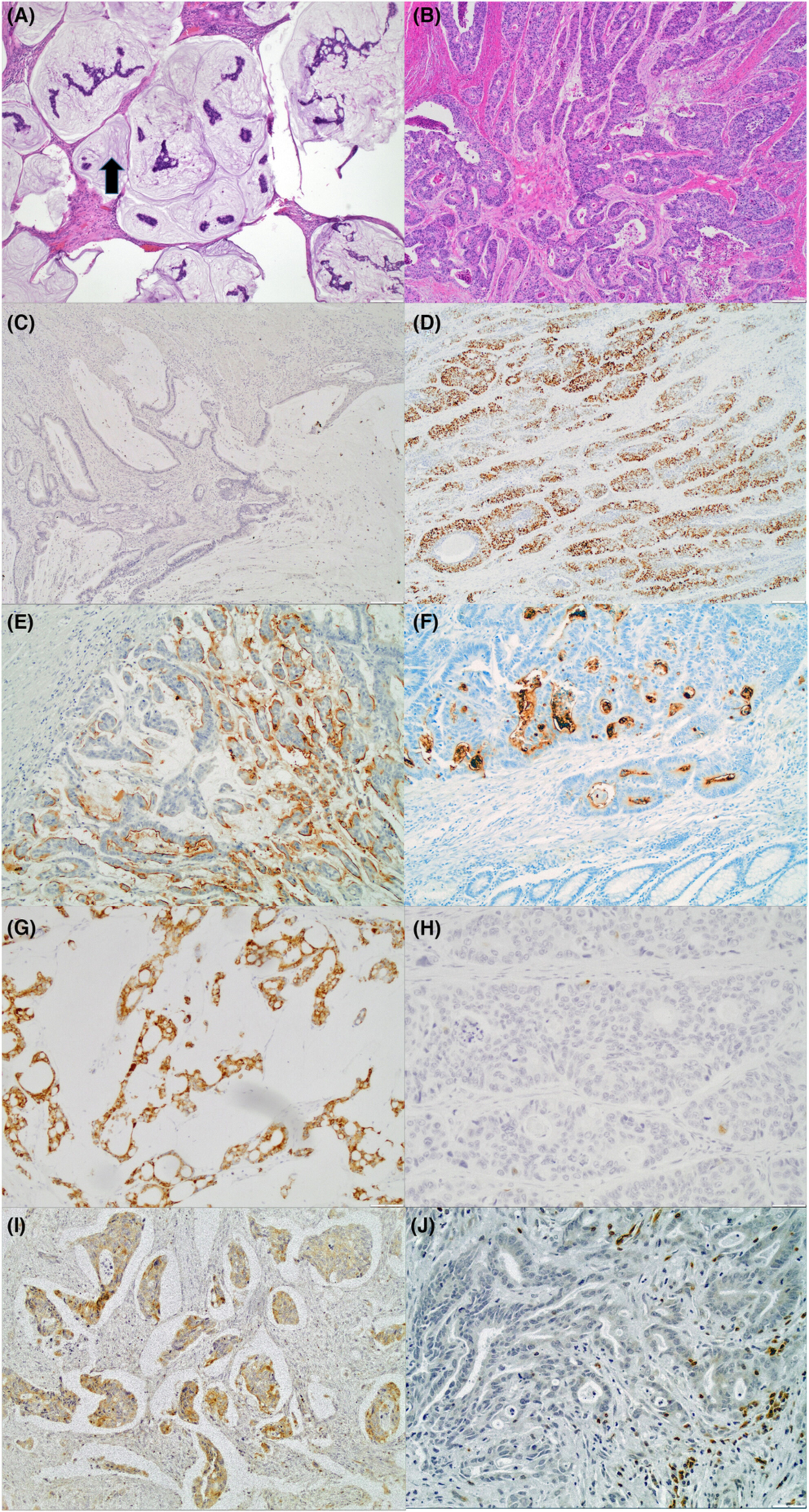Immunophenotypic profiles and prognosis for colorectal mucinous adenocarcinomas are dependent on anatomic location