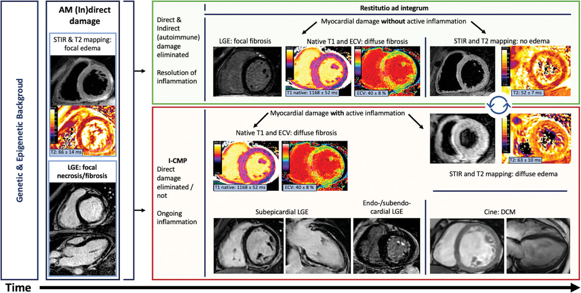 Acute Myocarditis and Inflammatory Cardiomyopathies: Insights From Cardiac Magnetic Resonance Findings