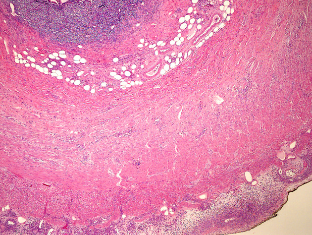 Acute appendicitis caused by acute myeloid leukemia