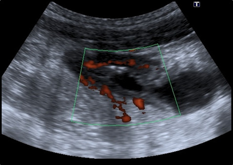 Comparison of small intestinal contrast ultrasound with magnetic resonance enterography in pediatric Crohn's disease
