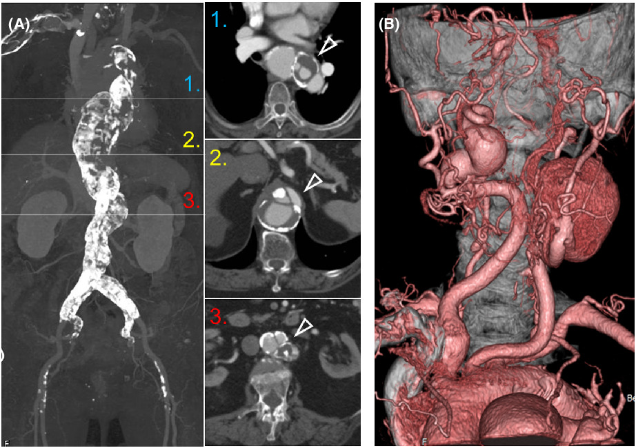Giant internal carotid artery aneurysms and porcelain aorta in an elderly patient with Marfan syndrome