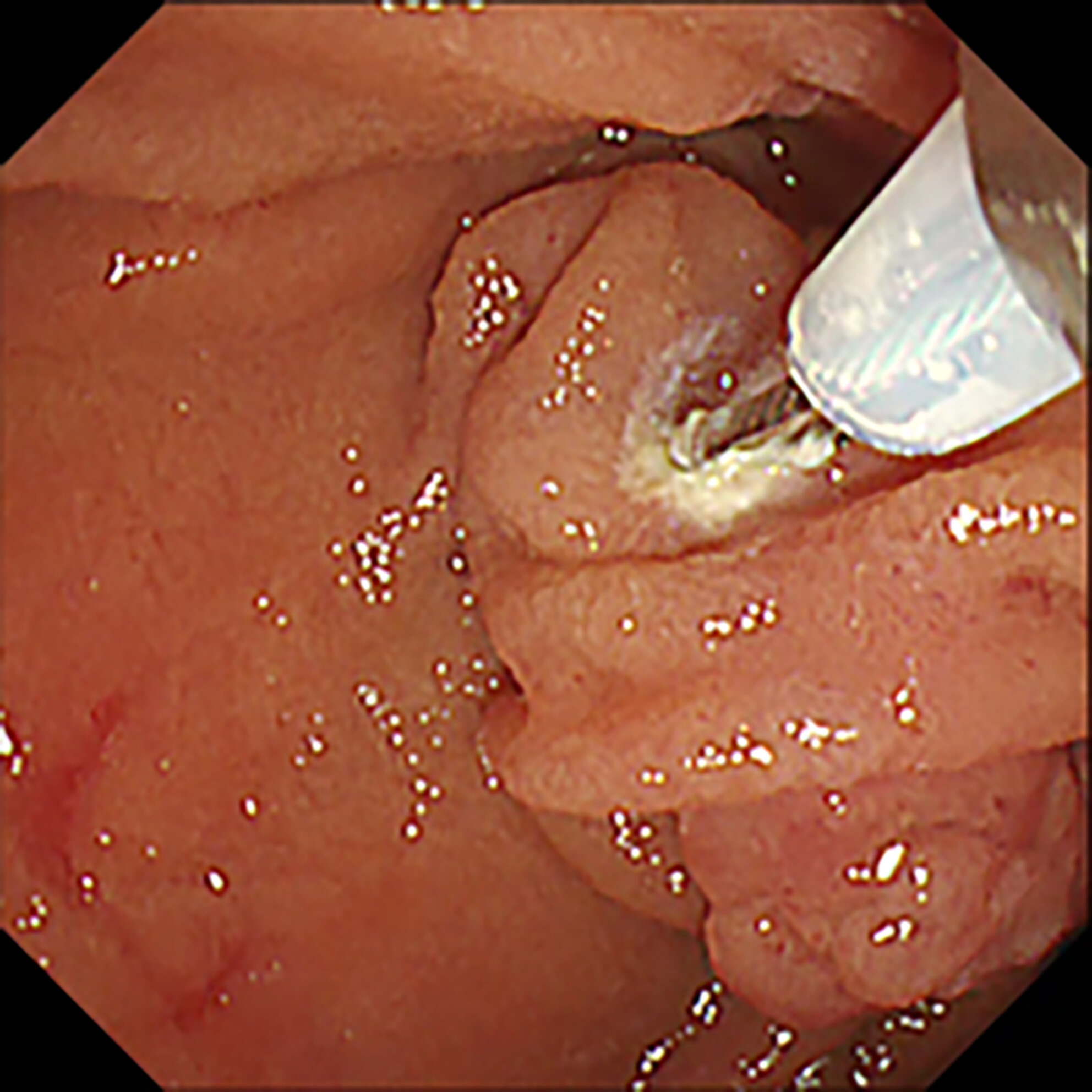 Tip-in endoscopic papillectomy for ampullary adenoma near diverticulum to minimize complications