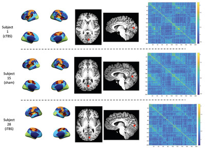 Continuous and intermittent theta burst stimulation of primary visual cortex do not modulate resting state functional connectivity: A sham-controlled multi-echo fMRI study