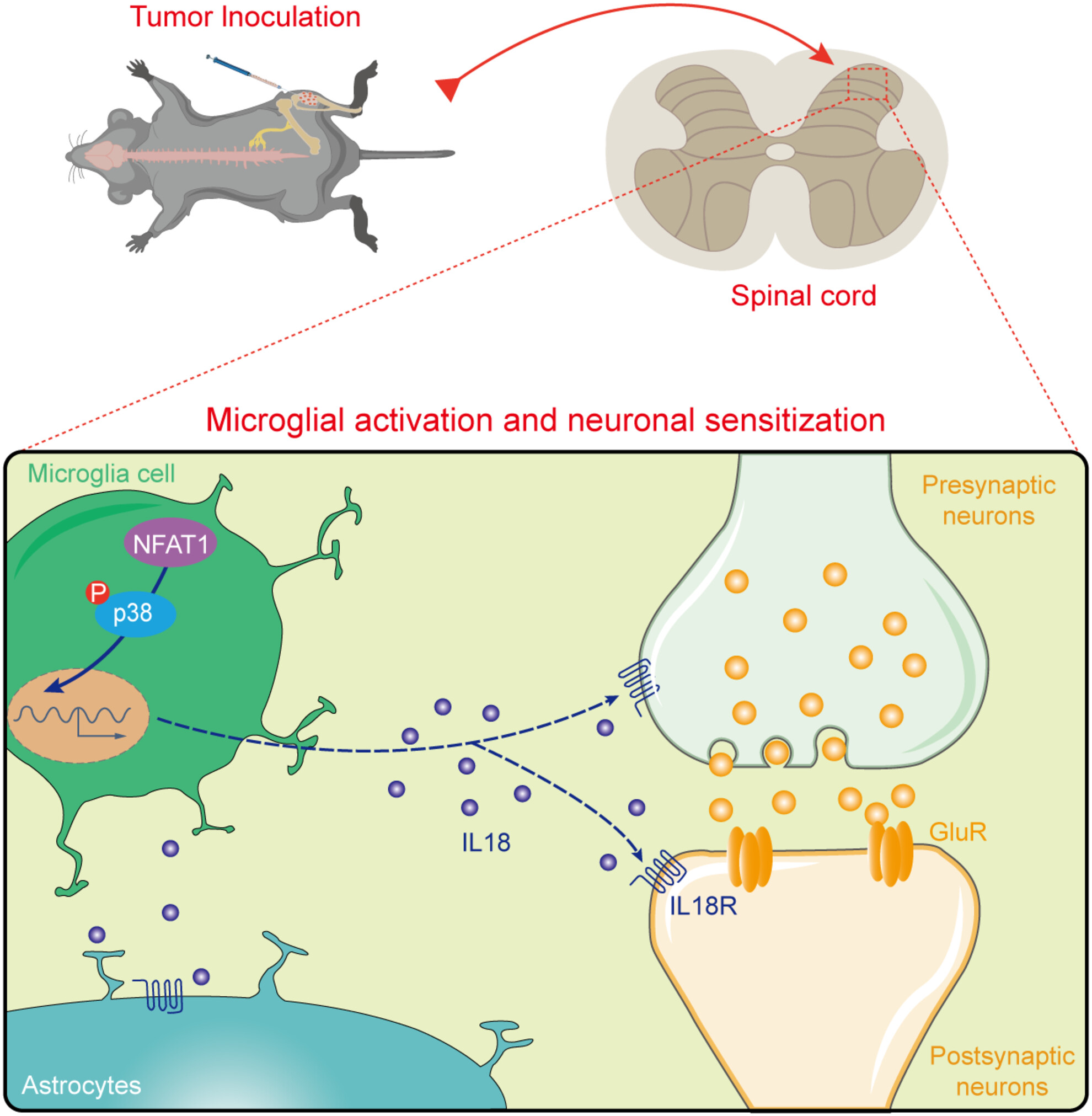 NFAT1 Signaling Contributes to Bone Cancer Pain by Regulating IL-18 Expression in Spinal Microglia