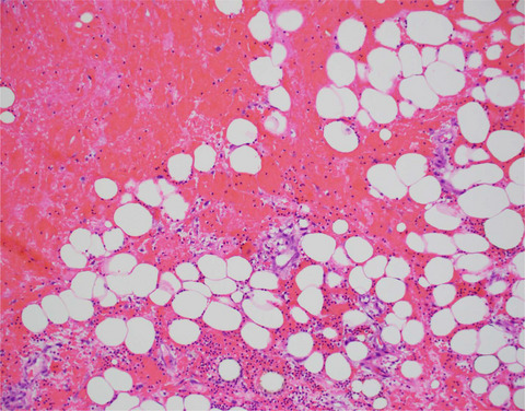 Recurrent soft tissue inflammation, necrotizing fascitis or Sweet syndrome, diagnostic dilemma