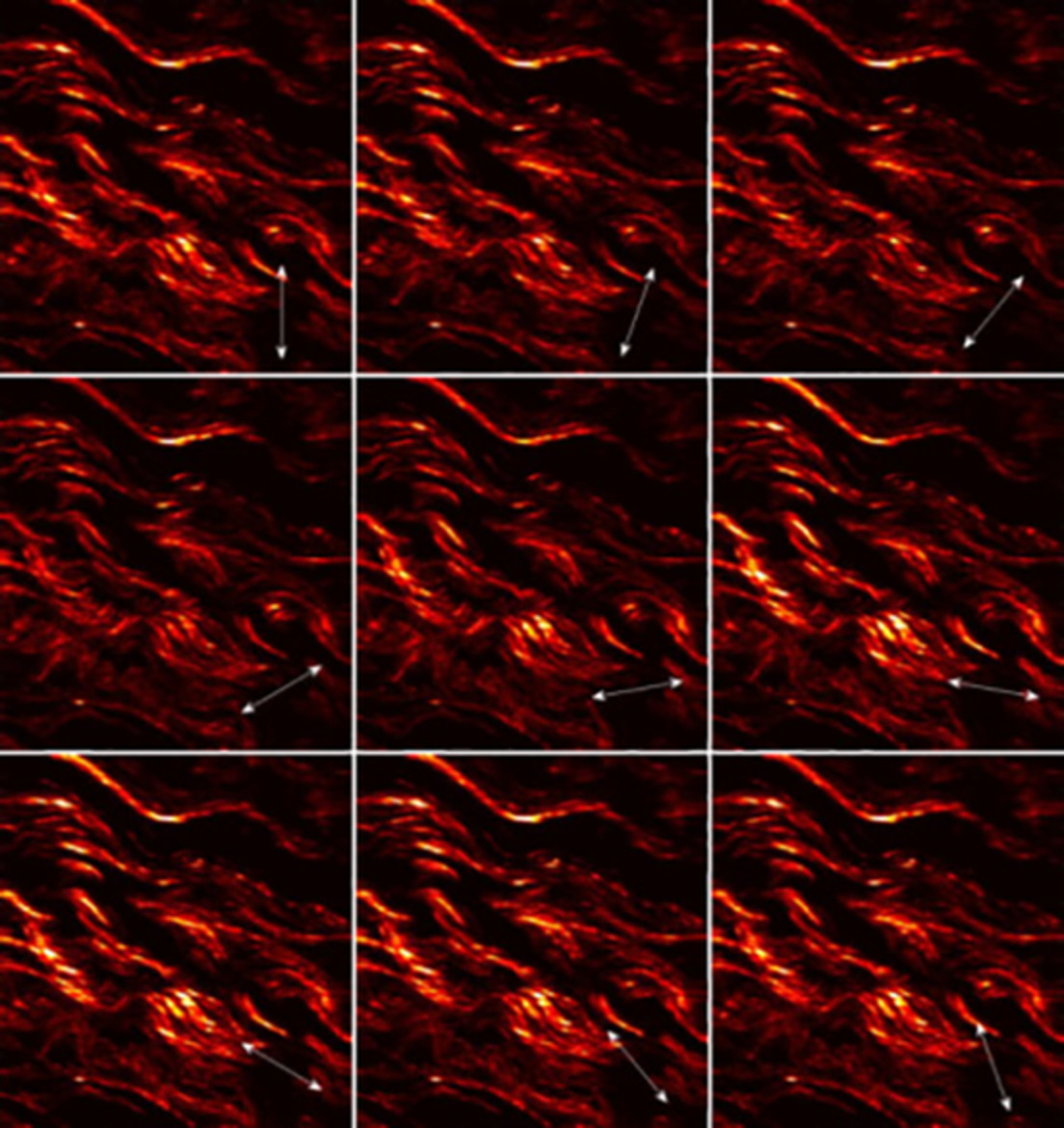 Polarization-dependent second-harmonic generation for collagen-based differentiation of breast cancer samples