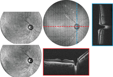 Spectrally encoded coherence tomography and reflectometry: Simultaneous en face and cross-sectional imaging at 2 gigapixels per second