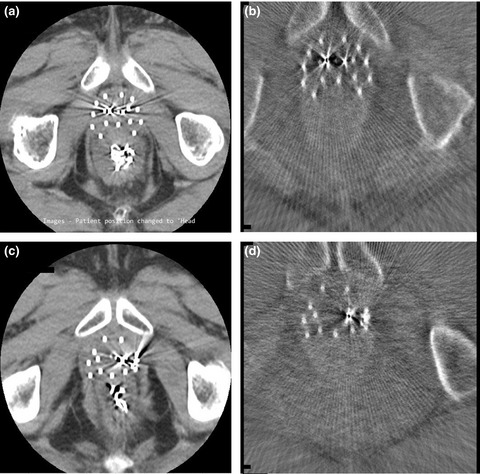 Evaluation of a mobile C-arm cone-beam CT in interstitial high-dose-rate prostate brachytherapy treatment planning