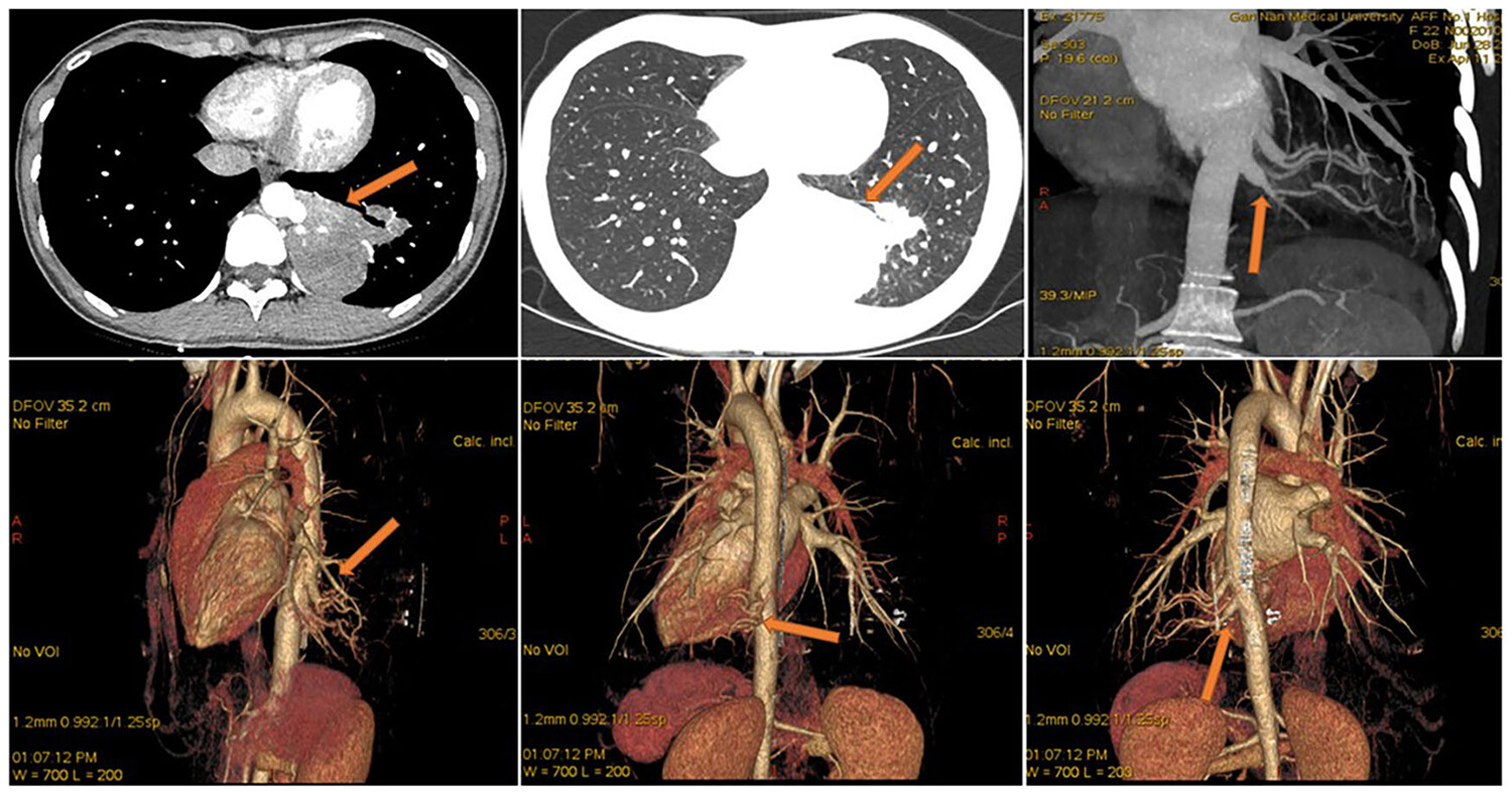 Imaging and pathological characteristics, treatment, and prognosis of pulmonary sequestration—A retrospective study of 13 cases