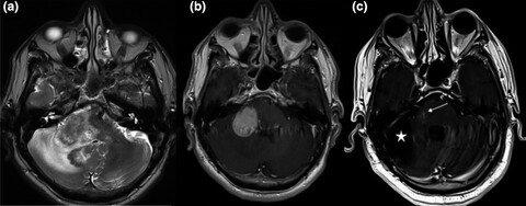 Good response to rituximab in chronic lymphocytic inflammation with pontine perivascular enhancement responsive to steroids presenting as tumor-like infratentorial lesion
