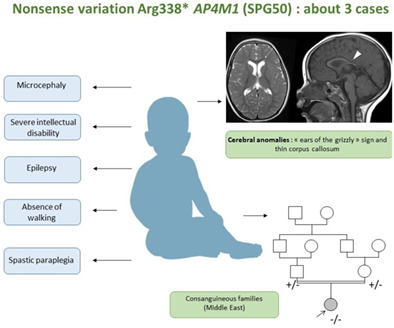 Putative founder effect of Arg338* AP4M1 (SPG50) variant causing severe intellectual disability, epilepsy and spastic paraplegia: Report of three families