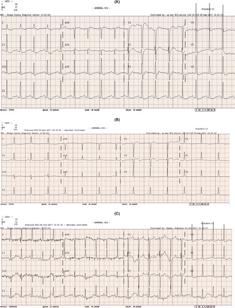 Doxorubicin-associated takotsubo cardiomyopathy in a patient with adult T-cell leukemia/lymphoma