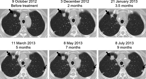 Phase I study of a new cancer vaccine of ten mixed peptides for advanced cancer patients