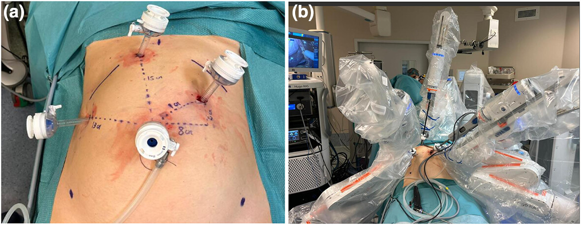 Full robotic cholecystectomy: first worldwide experiences with HUGO RAS surgical platform