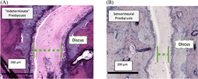 Ossicular joint histopathology in cases of age-related hearing loss
