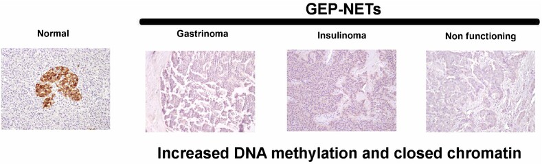 Calcium sensing receptor expression is downregulated in gastroenteropancreatic neuroendocrine tumours via epigenetic mechanisms