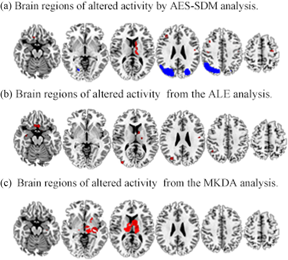 Regional abnormalities of spontaneous brain activity in migraine: A coordinate-based meta-analysis