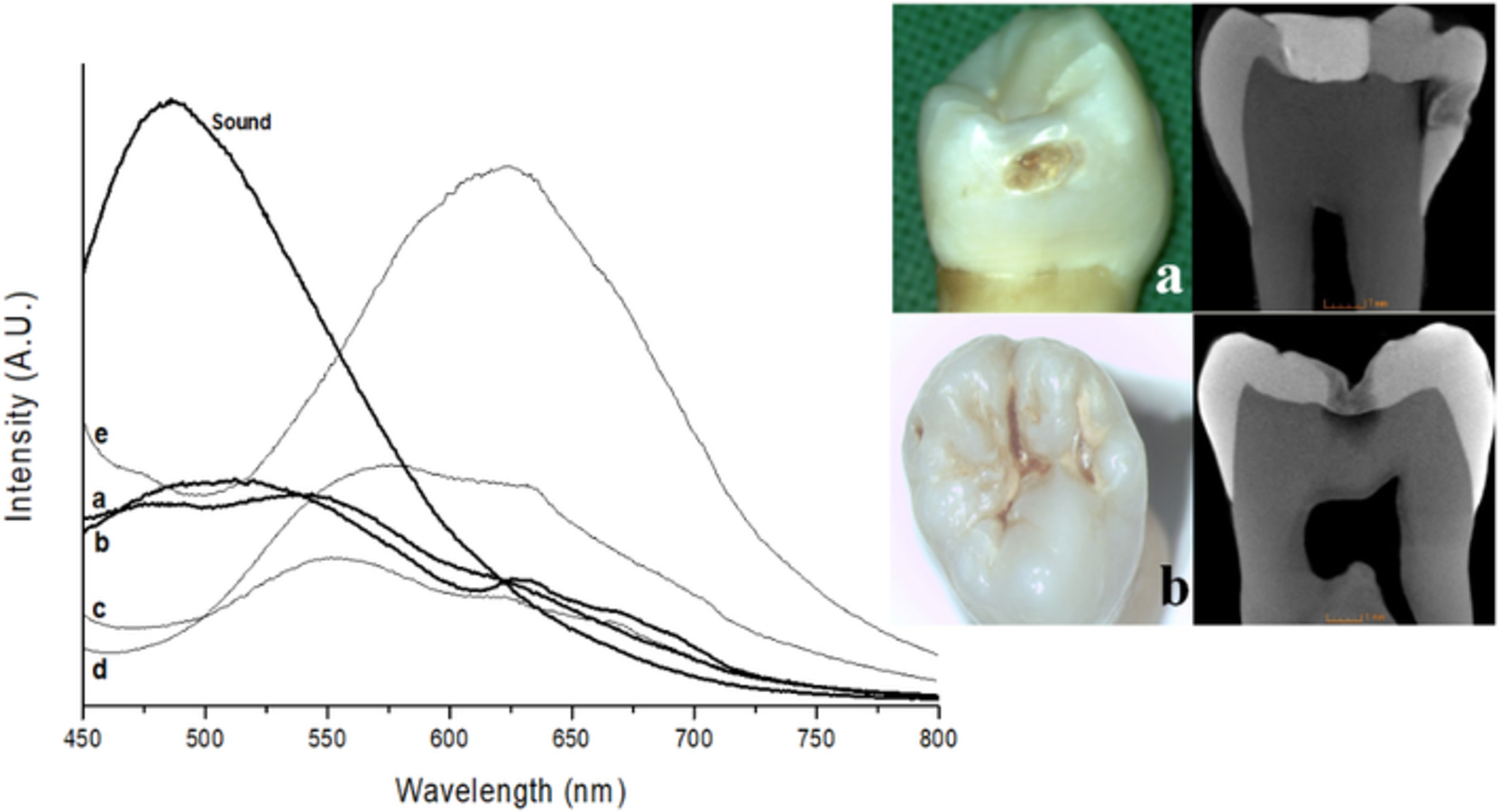 Spectral characteristics of caries autofluorescence obtained from different locations and caries severities