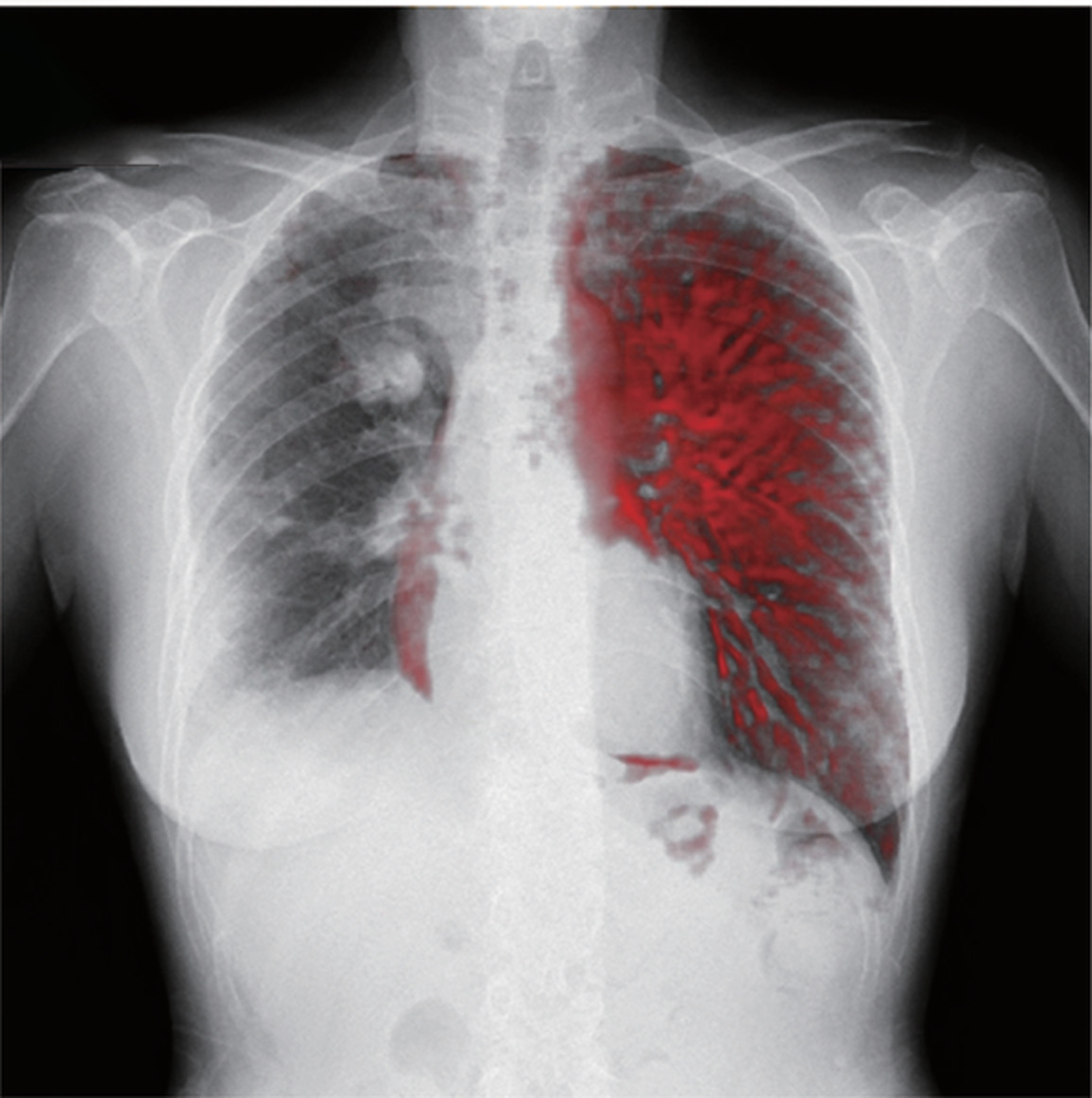 Novel pulmonary perfusion imaging using chest digital dynamic radiography for pulmonary artery sarcoma
