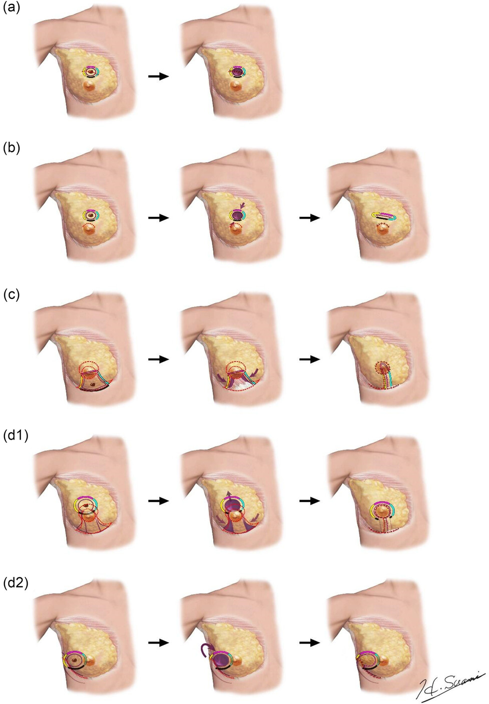 Oncoplastic breast surgery – a pictorial classification system for surgeons and radiation oncologists (OPSURGE)