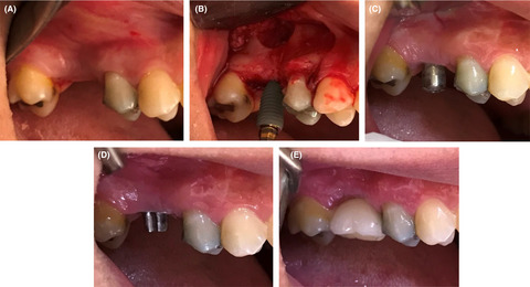 Maxillary sinus floor augmentation and simultaneous dental implant placement in a patient with Guillain-Barre syndrome: A case report
