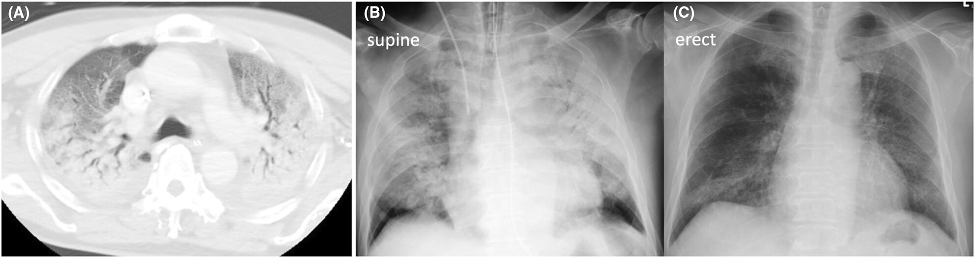 Severe acute respiratory distress syndrome caused by Otsujito
