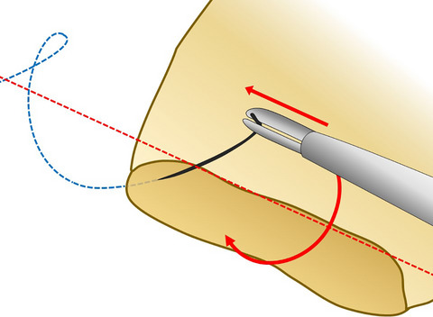 Basic knowledge of and a small trick for atraumatic needle driving in laparoscopic suturing