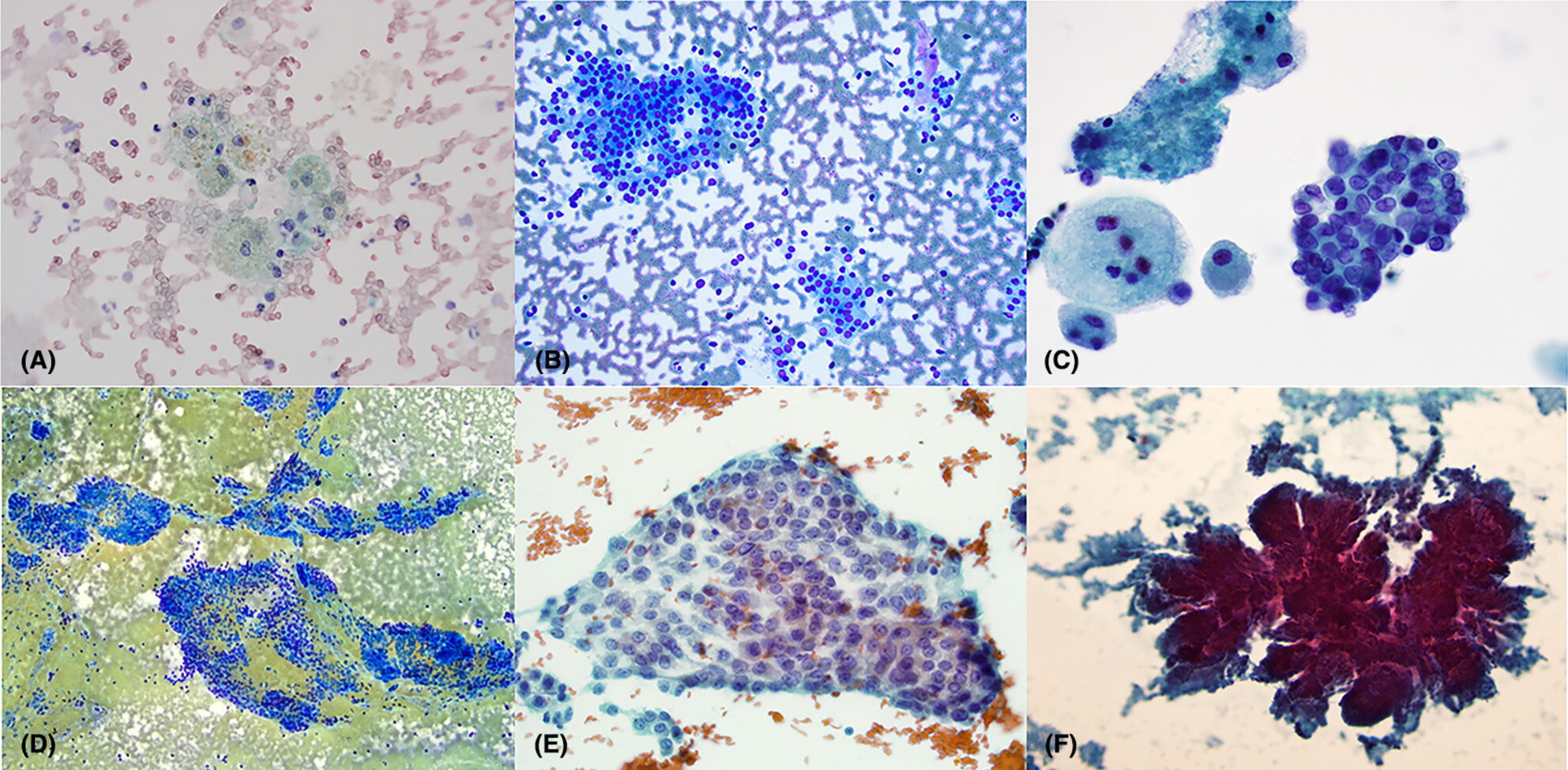 The Bethesda System for Reporting Thyroid Cytopathology in the African American population: A tertiary centre experience