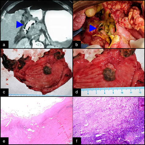 Invasive aspergillosis causing gastric necrosis and perforation: A case report