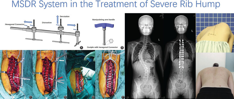 A Novel Multiple Screw Distraction Reducer System in the Treatment of Scoliosis with a Severe Rib Hump