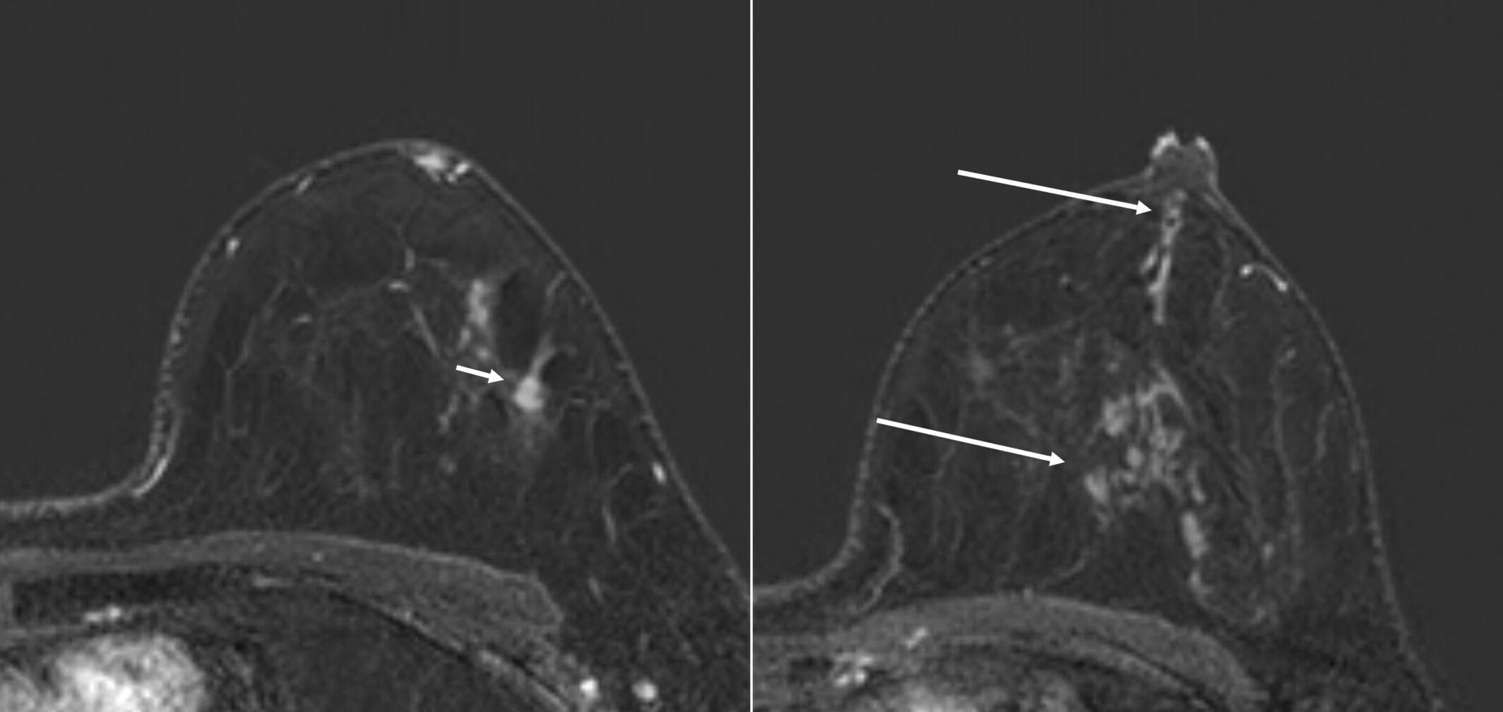 Additional occult cancers identified on staging breast MRI: imaging appearances and pathologic characteristics