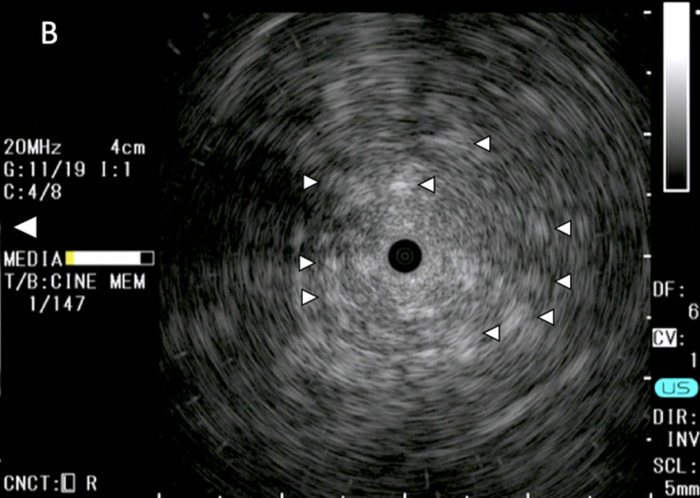 Snowball-like appearance on radial endobronchial ultrasonography in a patient with invasive mucinous adenocarcinoma