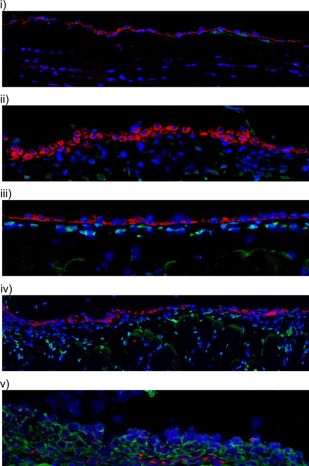 Crosstalk between the mesothelium and lymphomatous cells: insight into the mechanisms involved in the progression of body cavity lymphomas