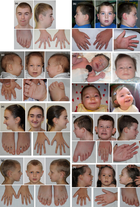 The phenotype-driven computational analysis yields clinical diagnosis for patients with atypical manifestations of known intellectual disability syndromes