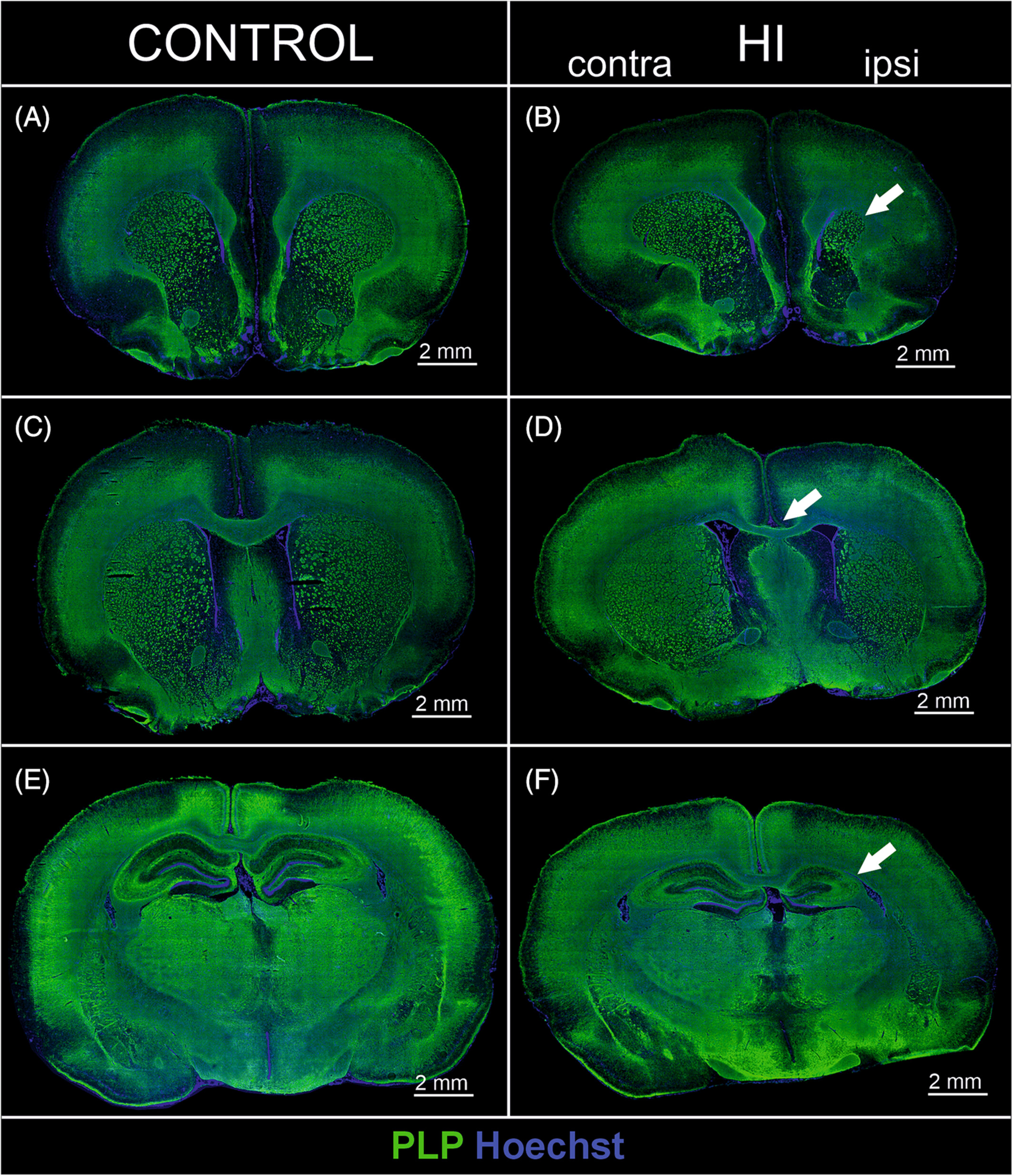 Oligodendrocyte progenitor cells' fate after neonatal asphyxia—Puzzling implications for the development of hypoxic–ischemic encephalopathy