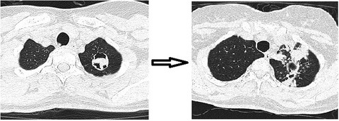 COVID-19 complicated with chronic necrotizing pulmonary aspergillosis and aspergilloma progressing to fibrosing aspergillosis: A case report