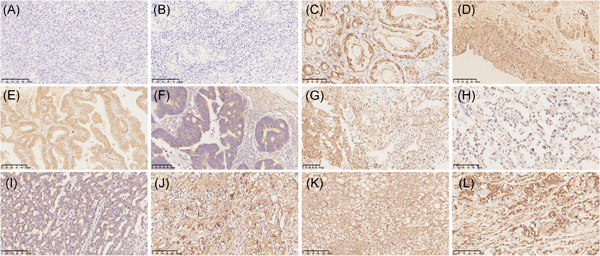 Cancer-testis antigen ACRBP expression and serum immunoreactivity in ovarian cancer: Its association with prognosis