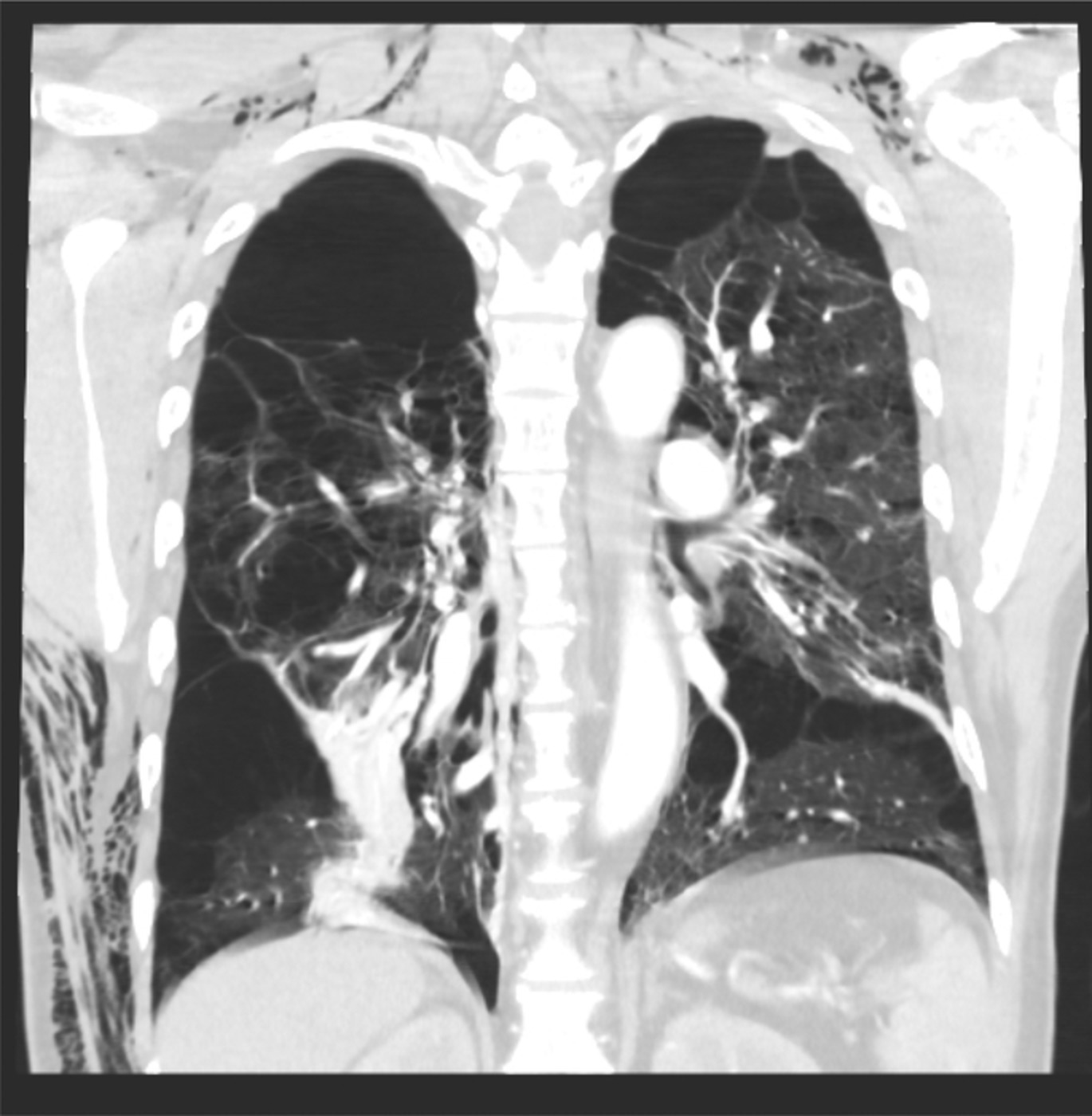 New pneumothorax complicating successful treatment of persistent air leak by endobronchial valves