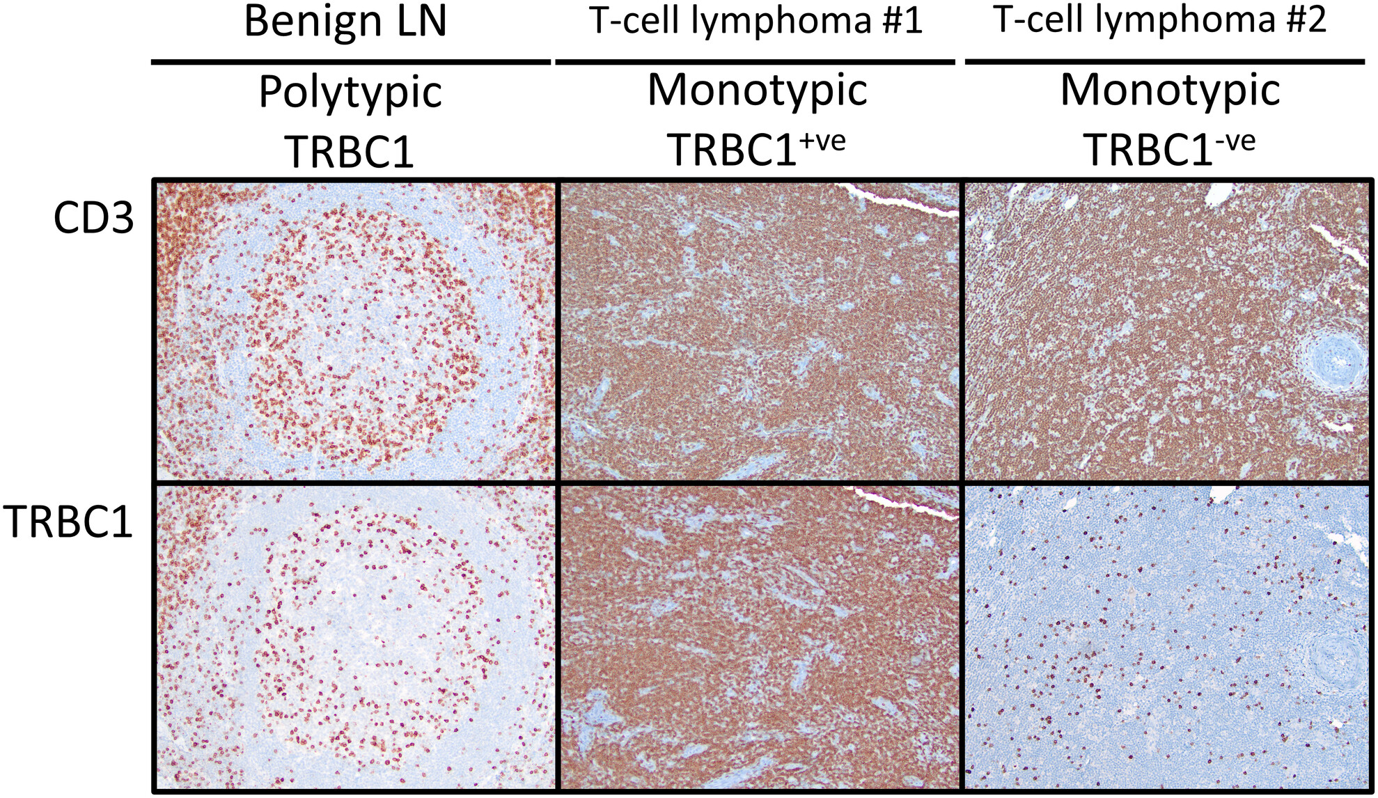 Expanding the use of T cell receptor beta constant 1 immunohistochemistry in formalin-fixed paraffin-embedded tissues in assessing T cell clonality in mature and immature T cell neoplasms