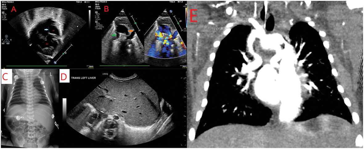 Multimodality Imaging of Bilateral Ductus Arteriosus in a Patient With Complex Heterotaxy and a Univentricular Heart