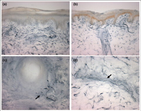 Unusual concomitant small- and large-fiber neuropathy related to hypereosinophilic syndrome