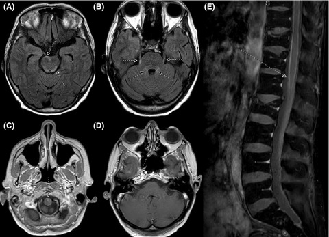 Cauda equina syndrome in an ovarian malignant-mixed müllerian tumor with leptomeningeal spread