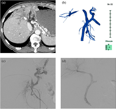 Percutaneous transhepatic portal vein stenting for malignant portal vein stenosis secondary to recurrent perihilar biliary cancer
