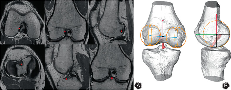 Race and Gender Differences in Anterior Cruciate Ligament Femoral Footprint Location and Orientation: A 3D-MRI Study