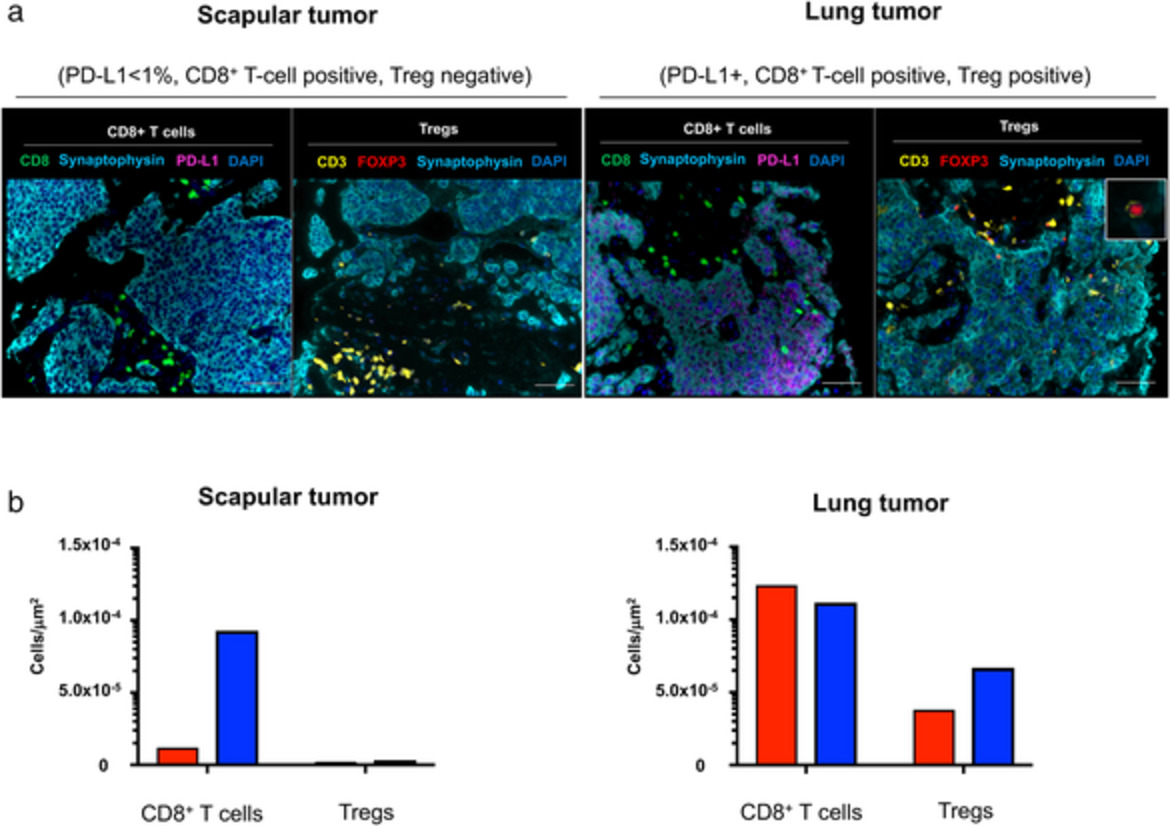 Heterogeneous tumor-immune microenvironments between primary and metastatic carcinoid tumors differentially respond to anti-PD-L1 antibody therapy