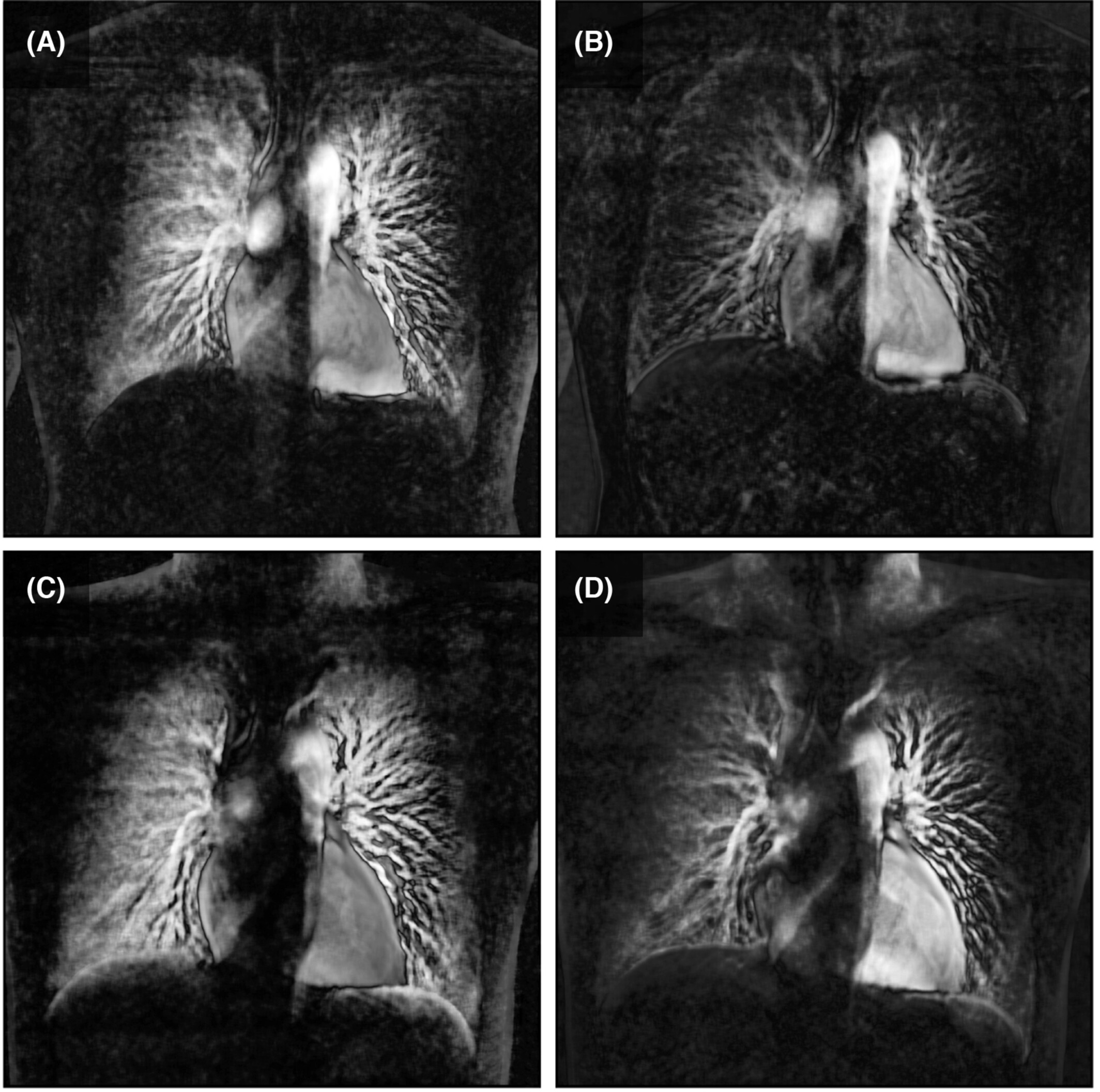Retracted: Chest digital dynamic radiography to detect changes in human pulmonary perfusion in response to alveolar hypoxia